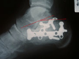 Radiograph showing reduction and internal fixation of the calcaneal fracture
