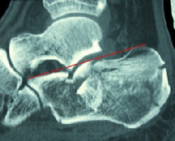 Radiograph of a depressed fracture of the calcaneus showing loss of Bohler's angle